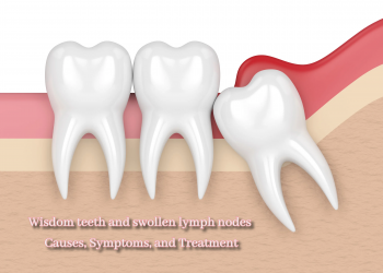 Wisdom teeth and swollen lymph nodes